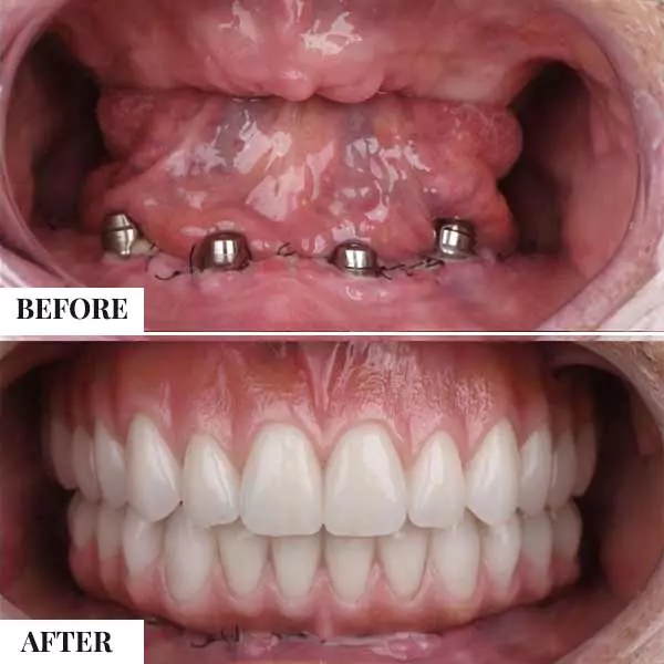 Before and after dental restoration showing lower jaw implants and full set of white teeth.