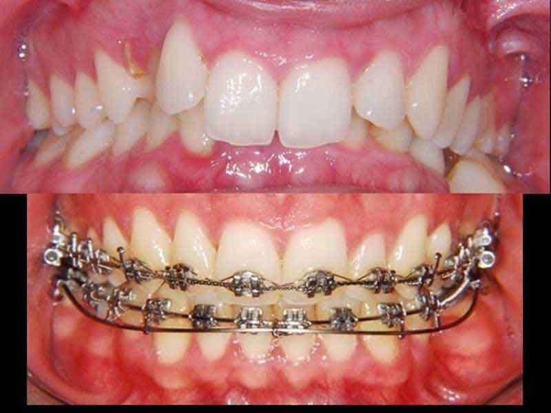 Comparison of misaligned teeth before and after treatment with metal orthodontic braces and wires.