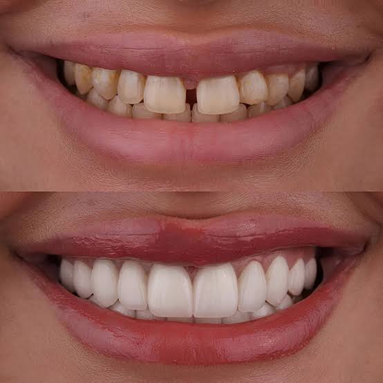 Before and after comparison of a smile showing yellowed, gapped teeth transformed into bright white, aligned teeth.