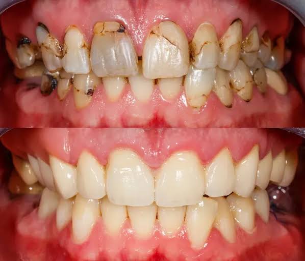 Before and after comparison of decayed, stained teeth transformed into a healthy, white smile.
